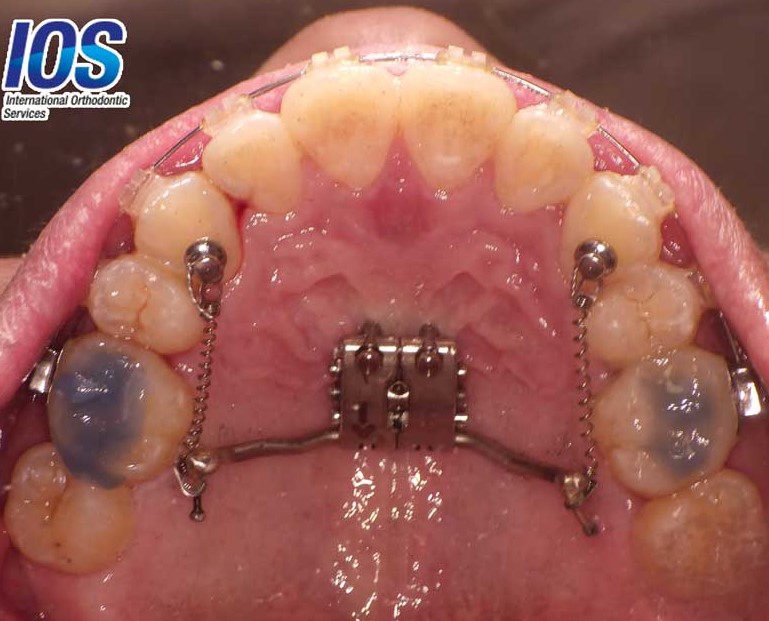 کلوز کویل نیکل-تیتانیوم اسپرینگ ارتودنسی (12mm, Medium) IOS